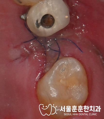 자양동치과 타치과 임플란트 수술 중 위턱 안쪽 공간 이탈 해결 의뢰 환자 방문