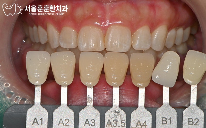 자양동치과 서울훈훈한치과 미백치료 사례로 확인하는 환한 웃음 변화 과정 정리