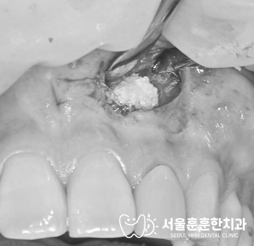 자양동치과 건강한 뿌리 끝과 염증 뿌리 끝 엑스레이 비교 주의사항