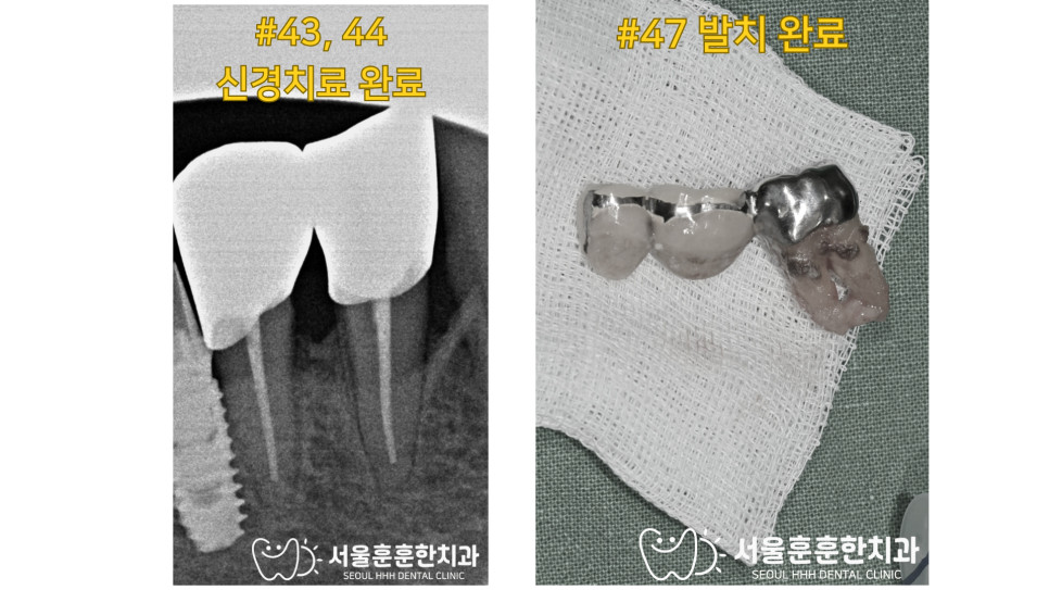 자양동수면치과 잘하는곳 파노라마 사진 기준 브릿지 통증 첫 진단 방법 확인