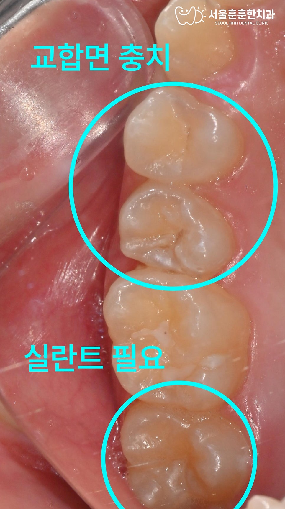 자양동치과 아이 어금니 깊은 홈 구조와 성인보다 쉬운 충치 위험 주의사항