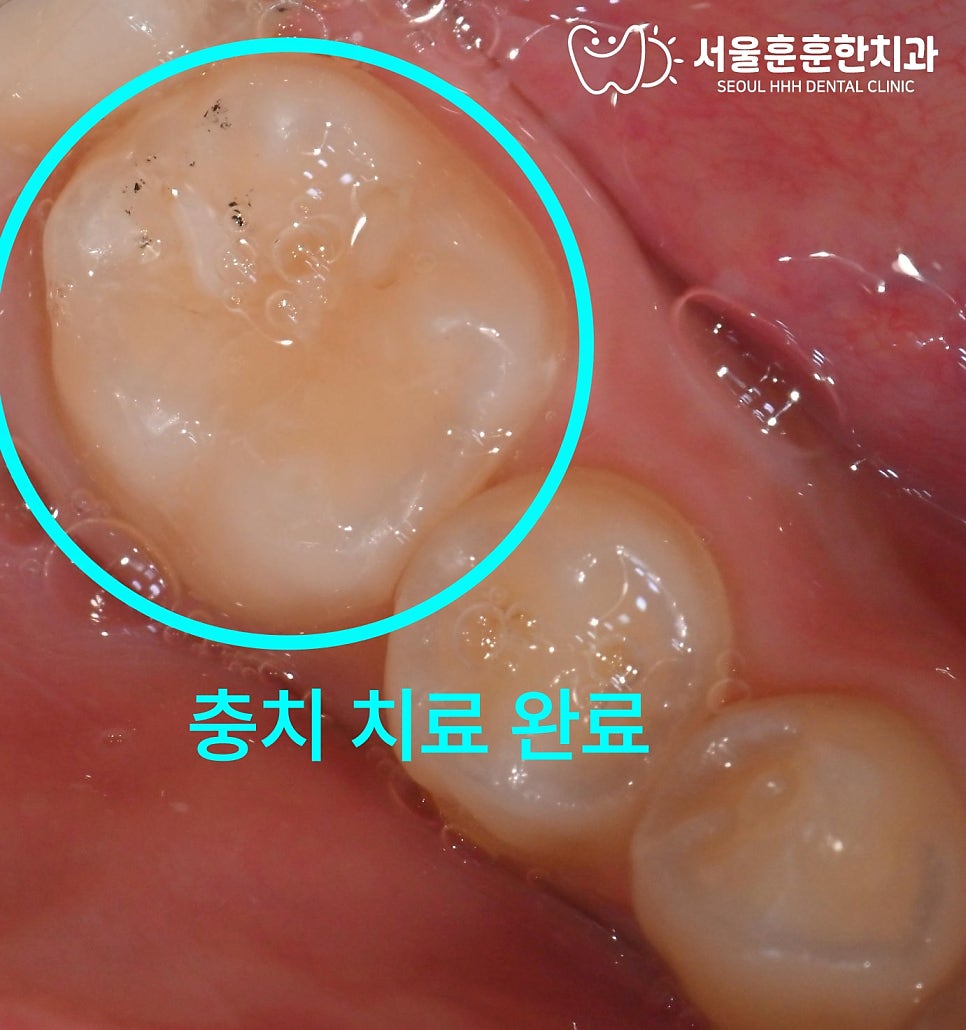 자양동치과 소아 충치 조기 발견 시 간단한 치료와 실란트 예방 방법 기준 정리