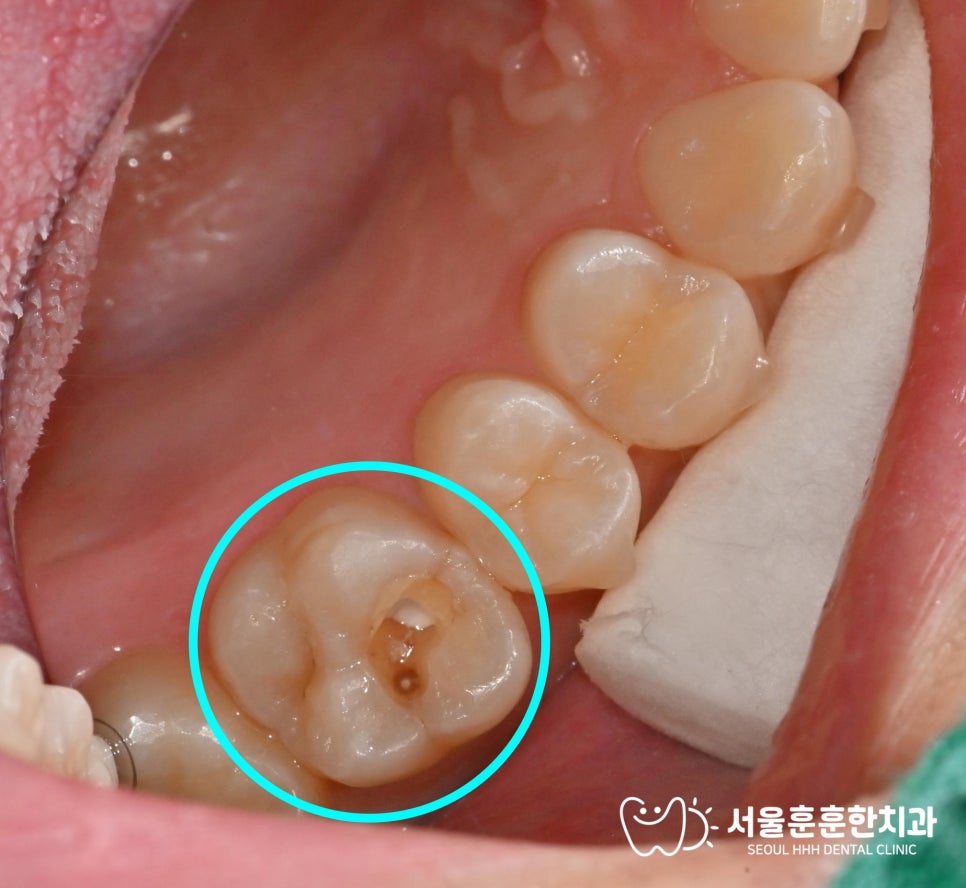 자양동치과 음식 끼임과 찬물 시림 증상 충치 확인 방법