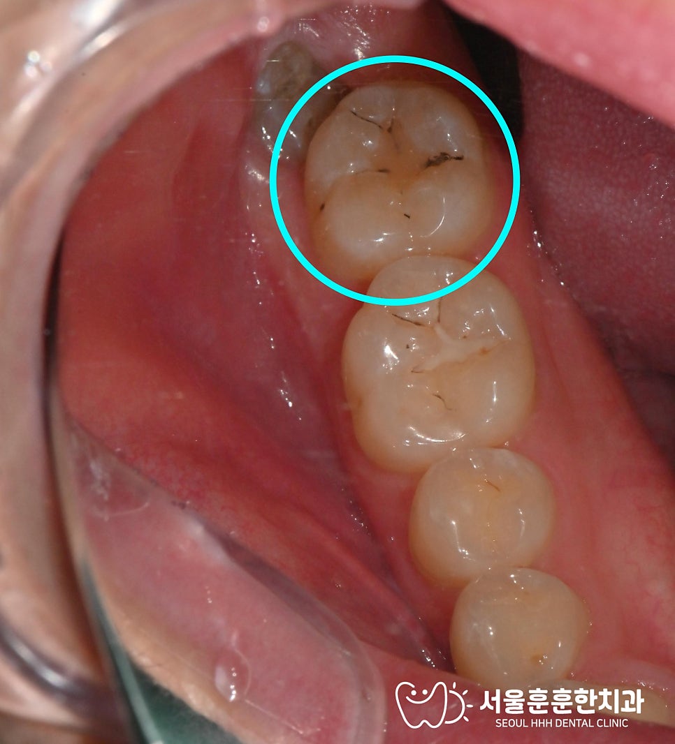 자양동치과 작은 치아 파절 방치 전 필요한 주의사항