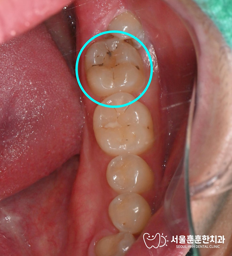 자양동치과 치아색 복합수지 레진빌드업 치료 방법