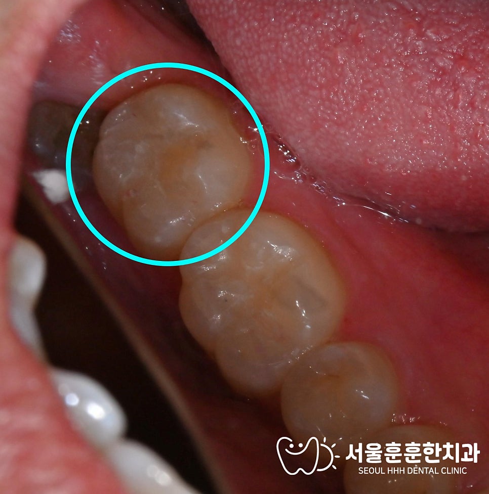 자양동치과 충치 치료에서 레진빌드업과 금니 비교