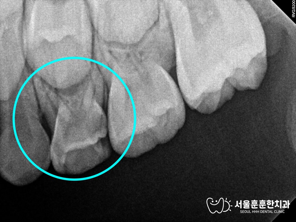 자양동치과 상악 좌측 첫째 유구치 64번 깊은 충치와 신경 감염 주의사항