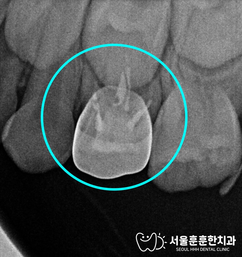 자양동치과 비가역적 치수염 유치 신경치료와 단순 충치 치료 한계 차이 비교