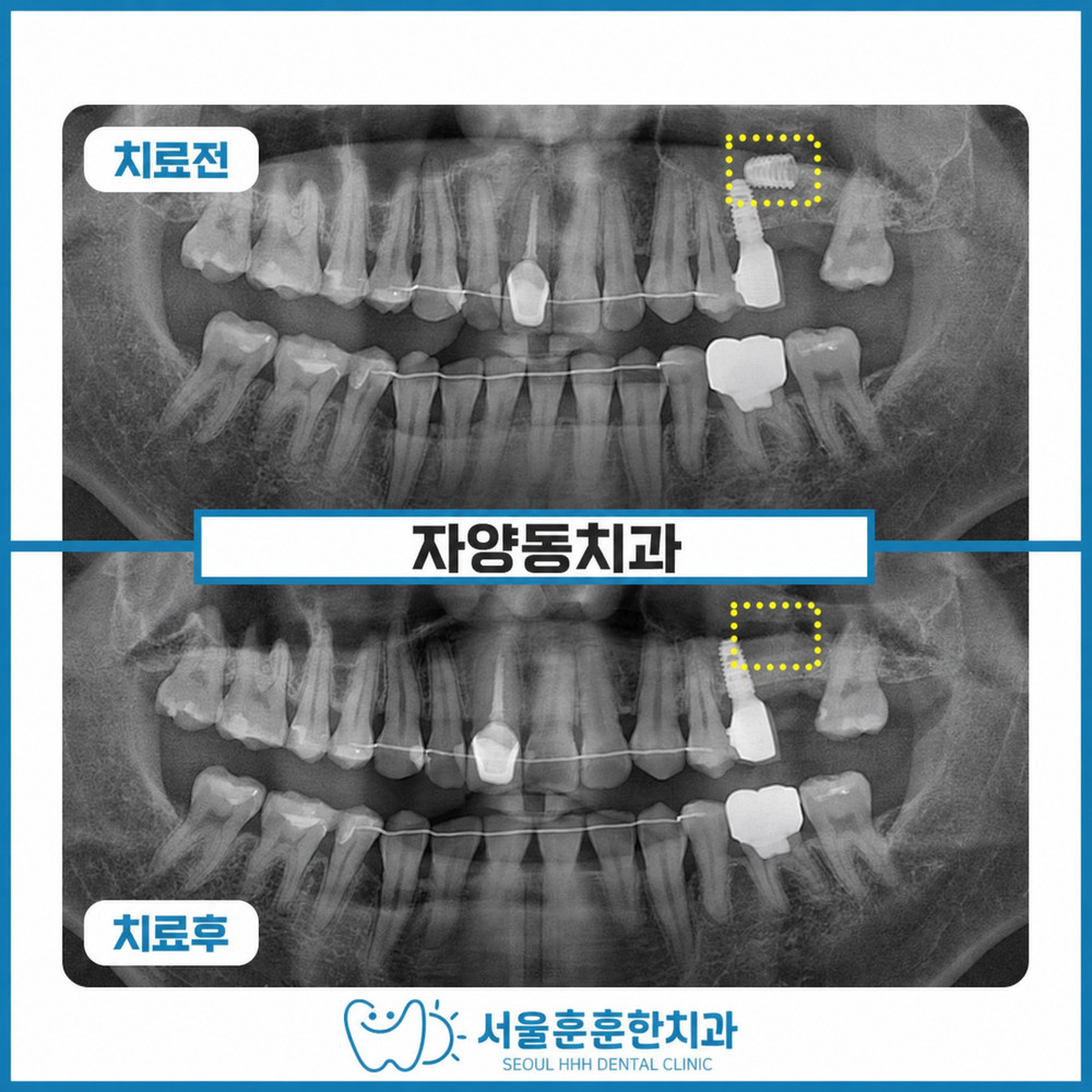 자양동치과 추천 서울훈훈한치과 상악동에 빠진 임플란트 안정적 제거 치료사례
