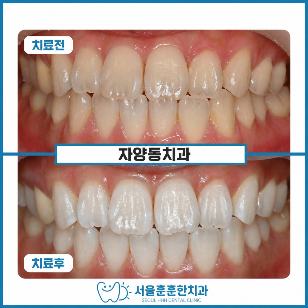 자양동치과 누런 치아로 입을 가리는 광진구치아미백 고민 확인점 정리 핵심