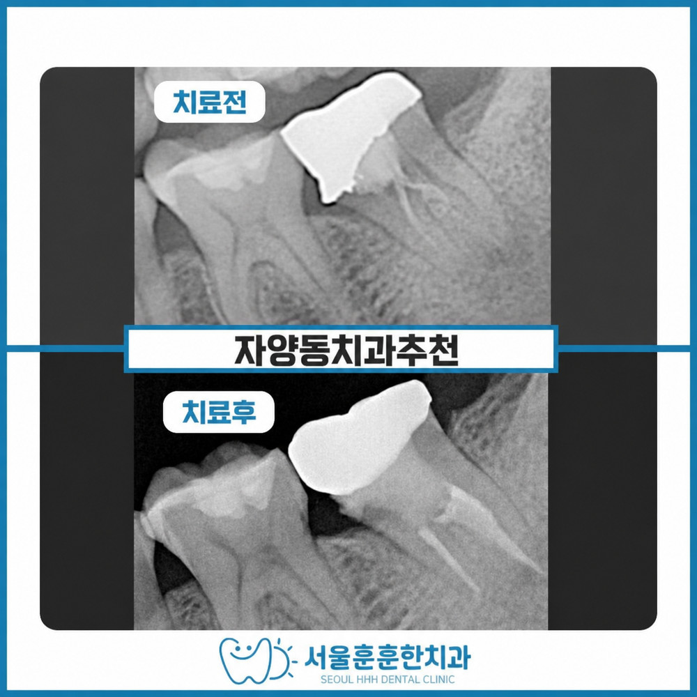 자양동치과추천 충치 치주 질환 조기 발견 자연치아 보존 발치 마지막 선택 기준