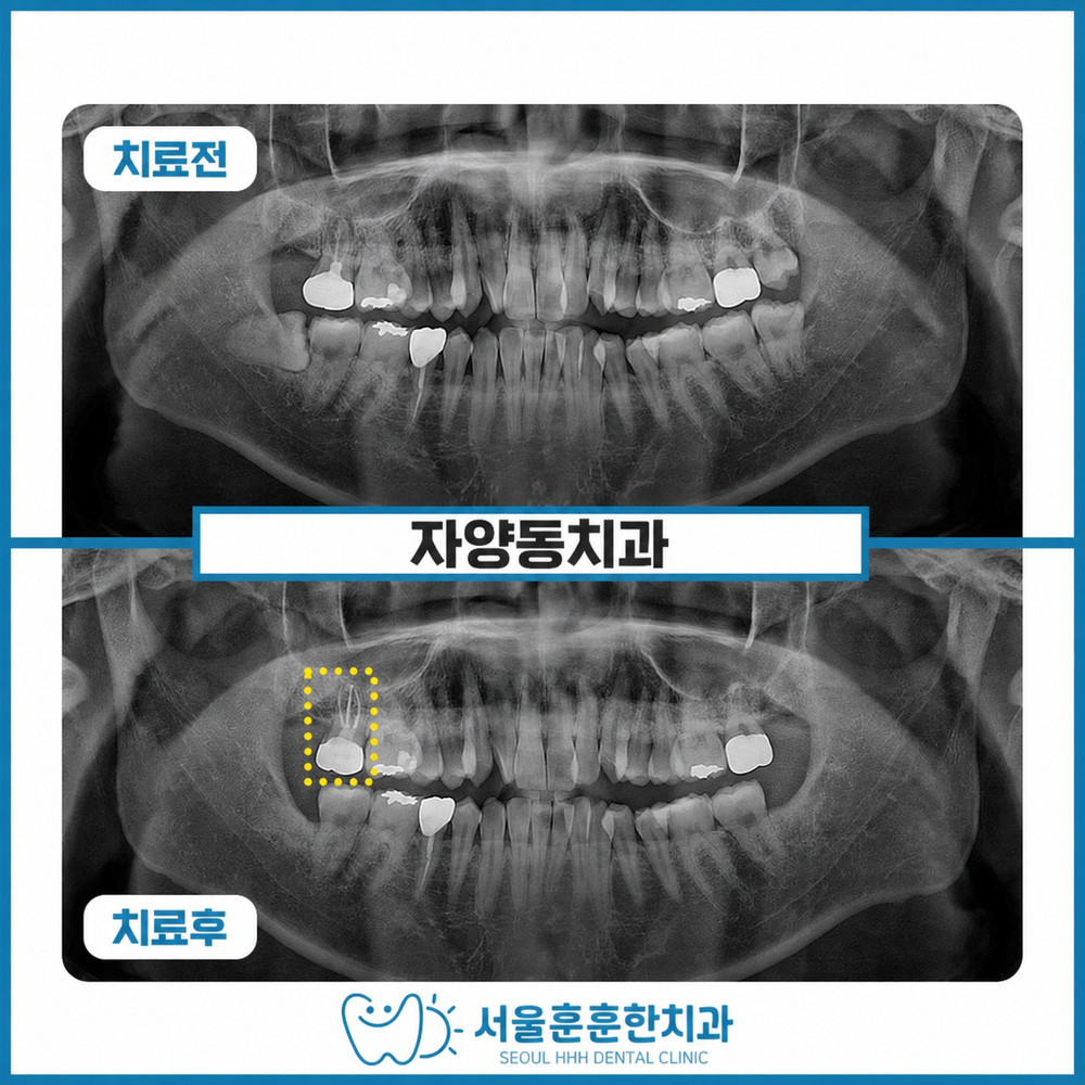 자양동치과 재신경치료 발치 전 자연치아 보존 가능성 확인 방법 서울훈훈한치과