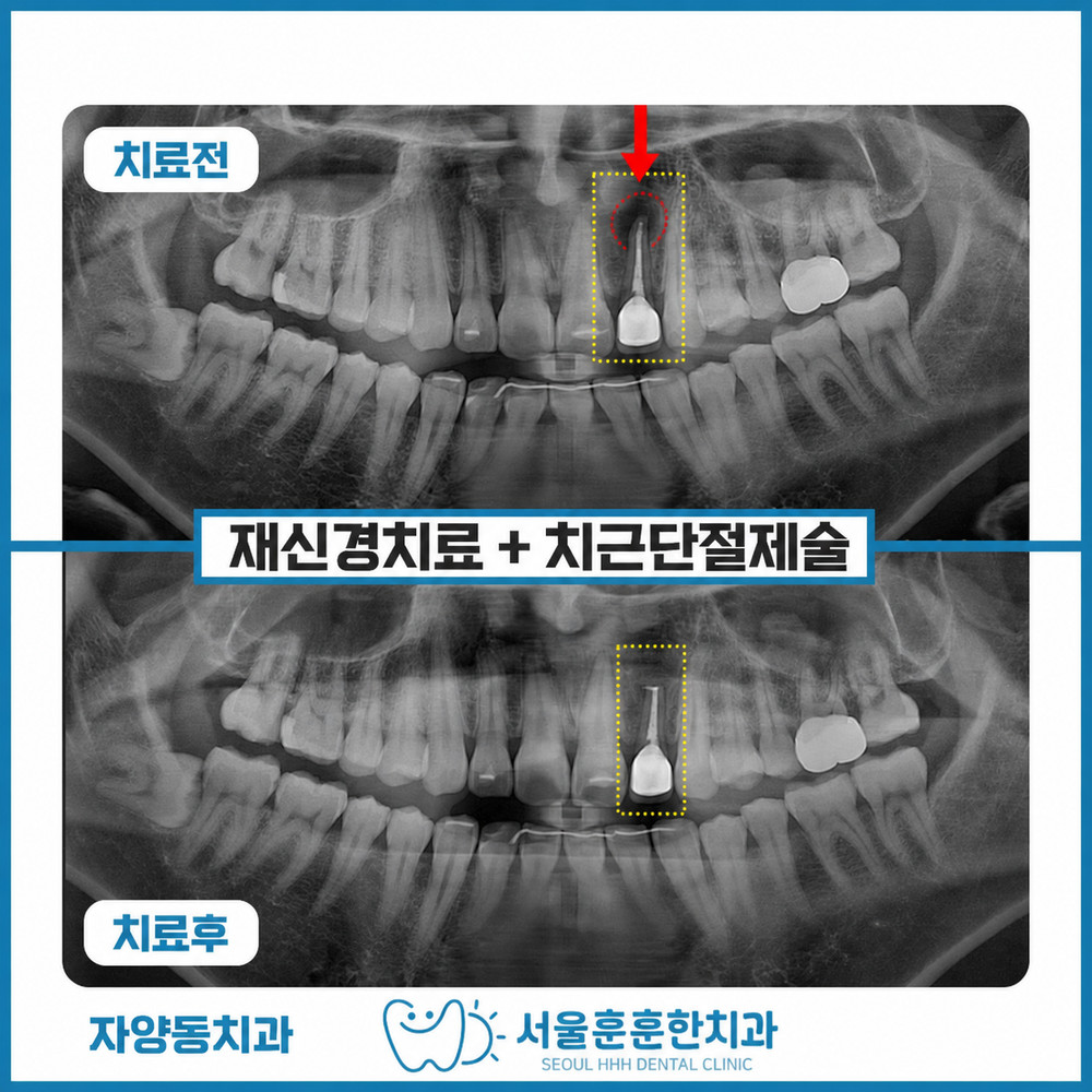 자양동치과 자연치아 보존 진료 방향과 발치 최소화 치료사례 핵심 기준