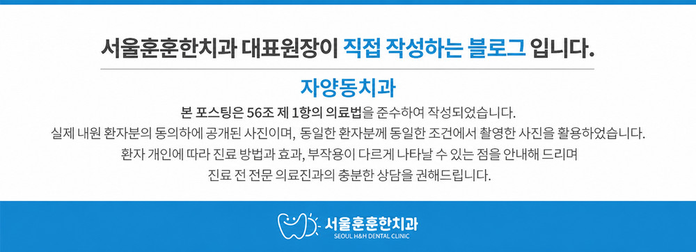자양동치과 작은 충치와 깨진 어금니 레진빌드업 치료 사례