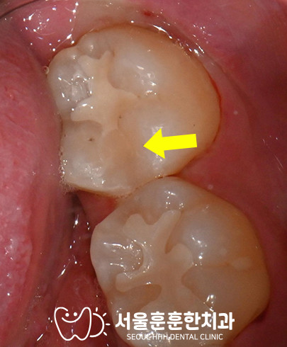 자양동치과 왼쪽 첫번째 어금니 인접면 충치 진단과 위치 특성별 치료 방법