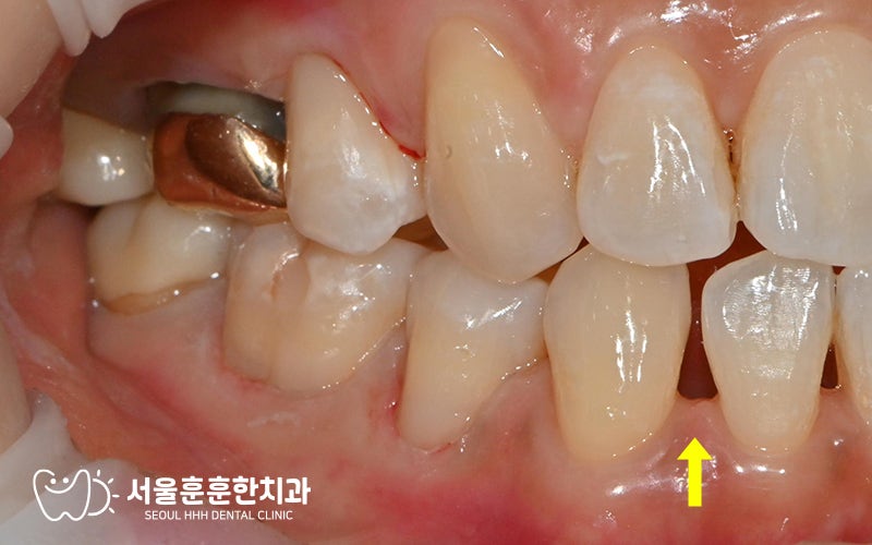 광진구치과추천 치아 사이 공간 치료 방법 레진 크라운 부분 교정 비교 선택 기준