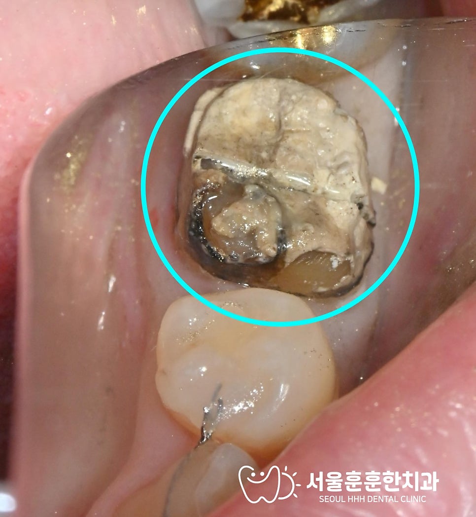 건대치과추천 크라운 구멍 음식물 세균 침투와 이차 충치 위험 조기 치료 이유