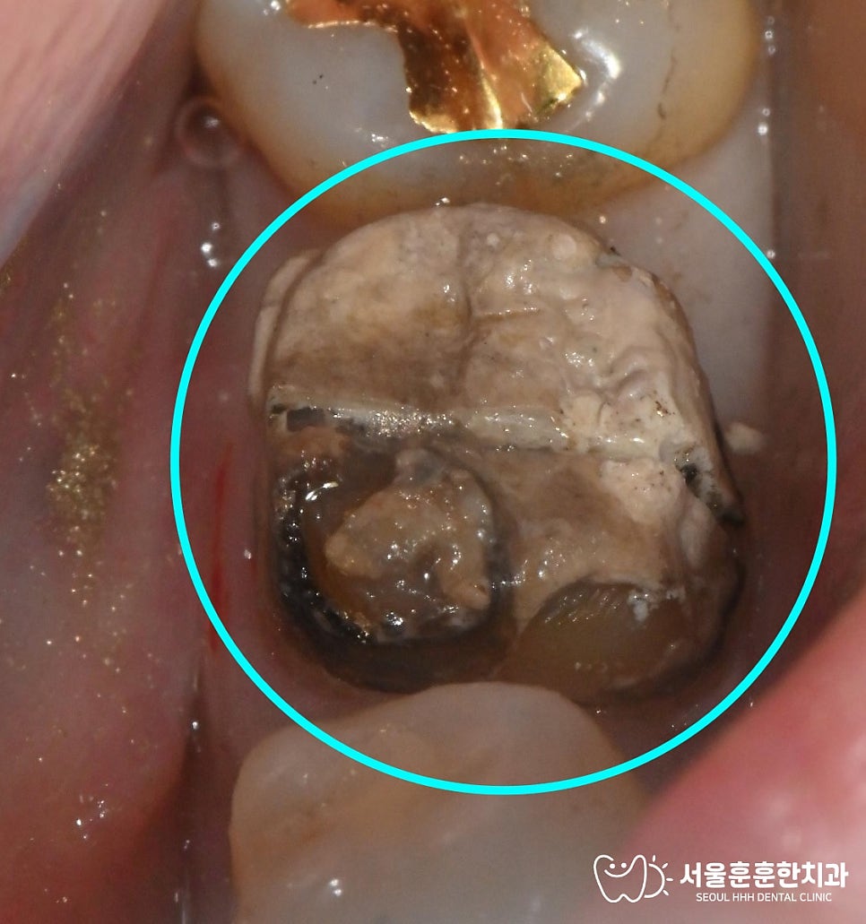 건대치과추천 금니 충치 골드크라운 지르코니아 교체 방법 변색 없이 해결