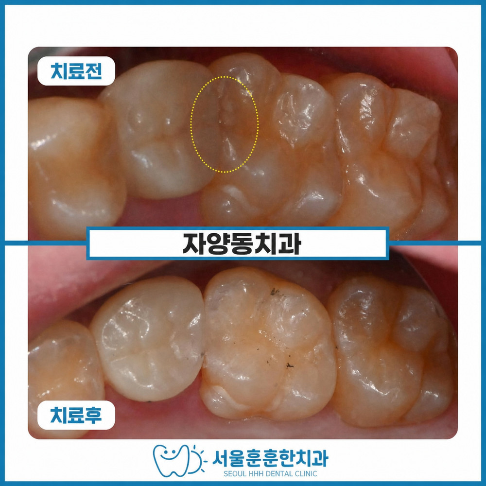 자양동치과 광진구 충치치료 자연치 보존 레진수복 치아삭제 최소화 선택 기준 사례