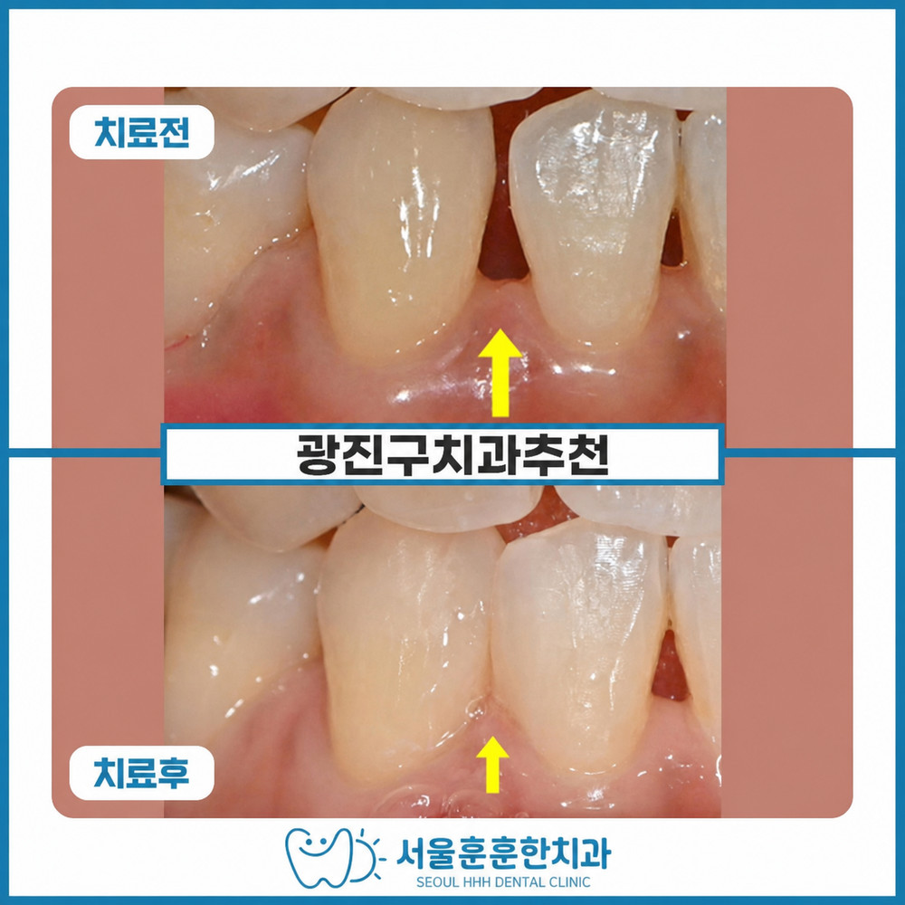 광진구치과추천 치아 사이 공간 고민과 웃을 때 말할 때 심미 상담 필요성