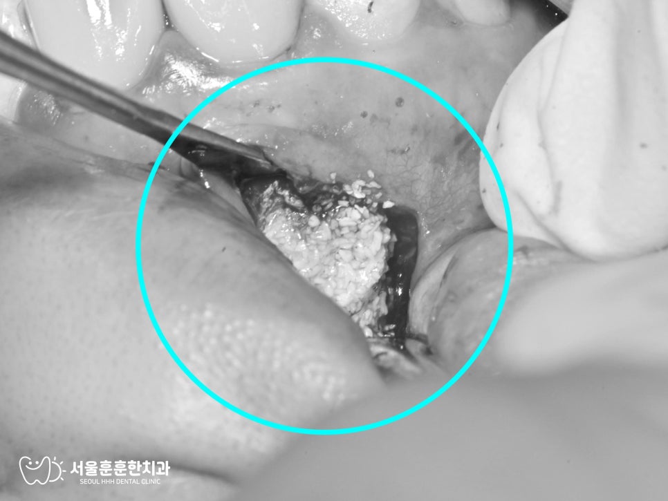 자양동치과 신경치료한 치아 뿌리 끝 염증성 병소 치근단 염증 상태 진단