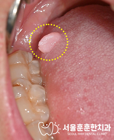 자양동치과 조직검사 결과 악성 소견 없는 양성 병변과 추가 치료 불필요 사례