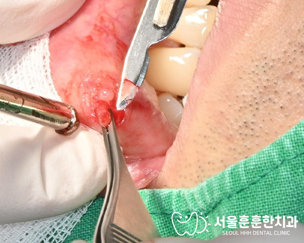 자양동치과 입안에 무언가 생겨 걱정된 환자 구강 병소 내원 상담 사례