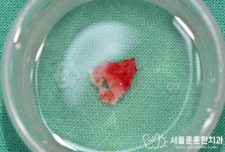 자양동치과 몇 달째 사라지지 않은 구강 병소 절제와 조직검사 의뢰 결정 과정