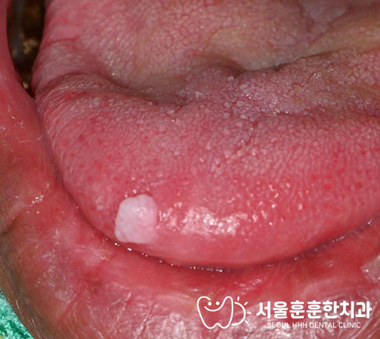 자양동치과 채취 조직 포르말린 고정 후 대학병원 조직검사 의뢰 방법 절차