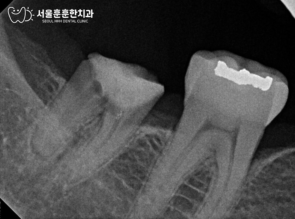자양동임플란트잘하는곳 오른쪽 아래 크라운 탈락 후 최근 식사 씹기 불편 원인