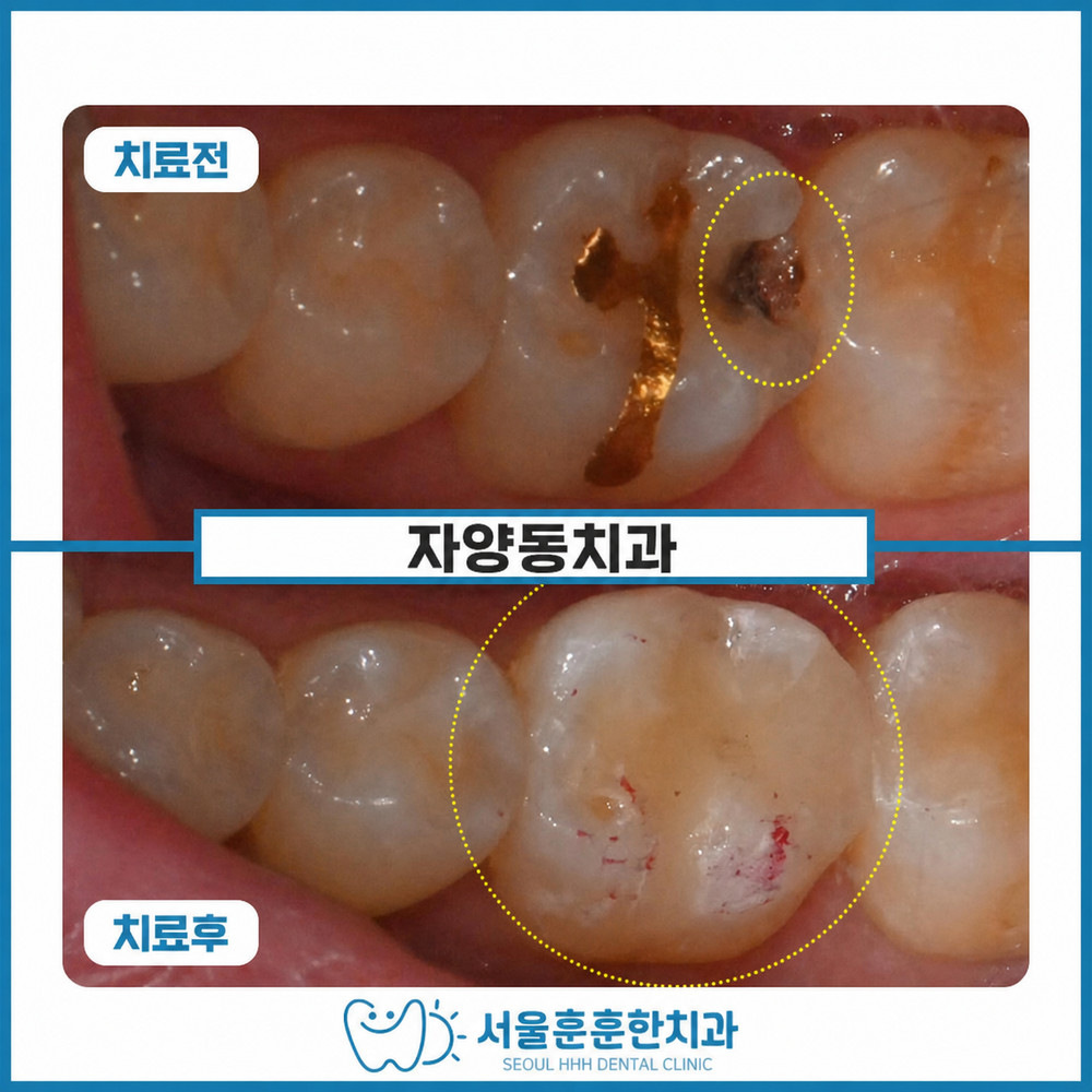 자양동치과 충치 수복 시 자연치 보존 레진치료 선택 방법 핵심 기준과 환자 안내
