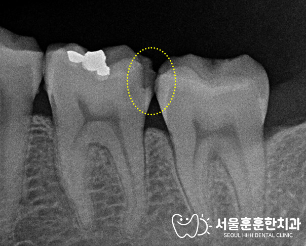 자양동치과 충치 제거 후 레진을 차곡차곡 쌓는 빌드업 치료 방법 상세 과정