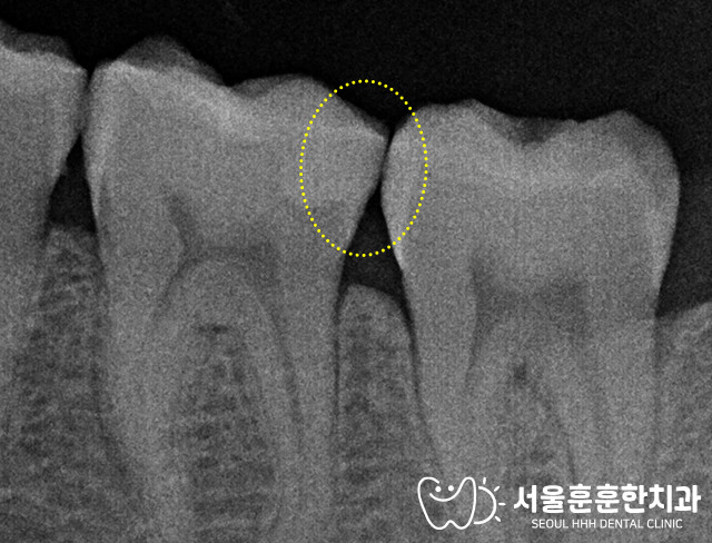 자양동치과 짧은 시간 안에 가능한 레진치료 기능 심미 개선 장점과 선택 기준