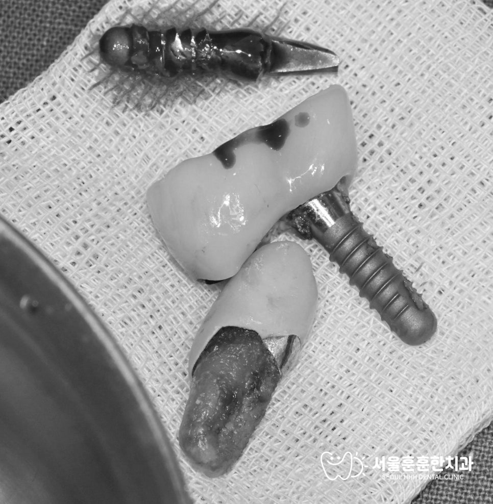 자양동치과 오른쪽 아래 임플란트 흔들림과 앞 치아 통증 증상 내원 사례