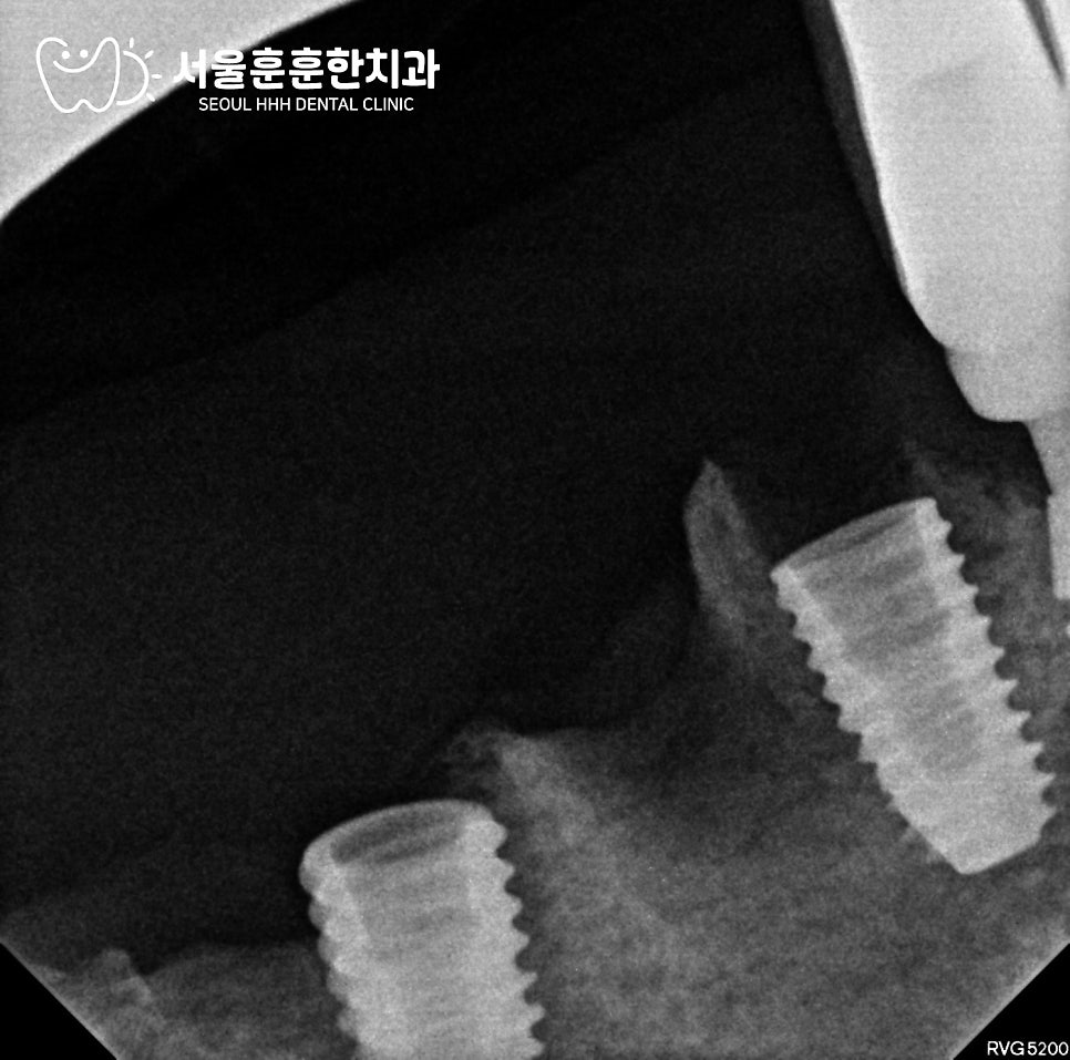 자양동치과 몇 달간 참은 임플란트 불편감과 통증 악화 전 진료 필요성