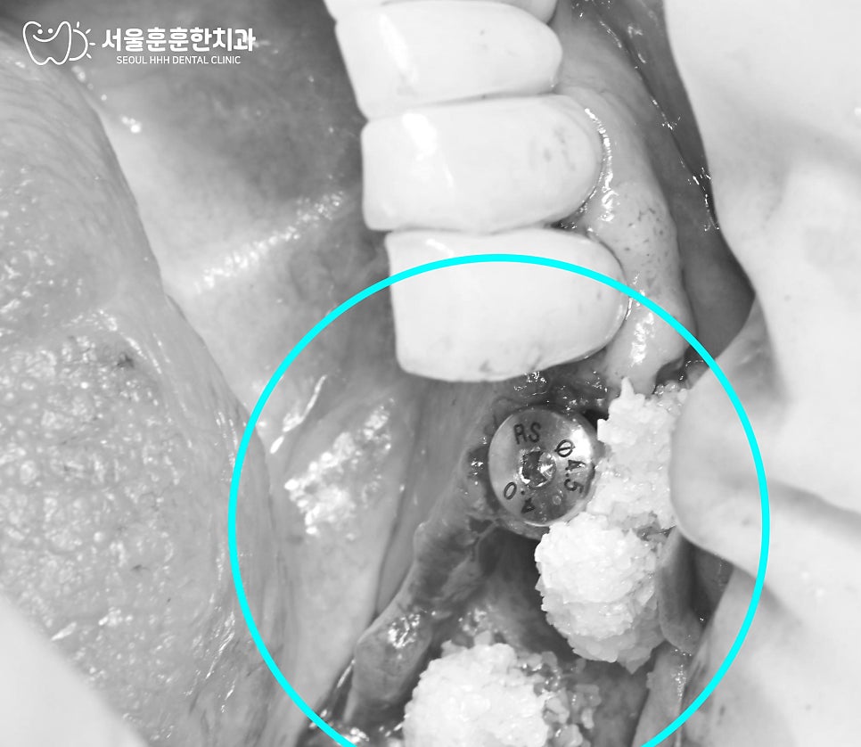 자양동치과 정밀 검사로 확인한 임플란트 흔들림의 예상보다 심각한 상태