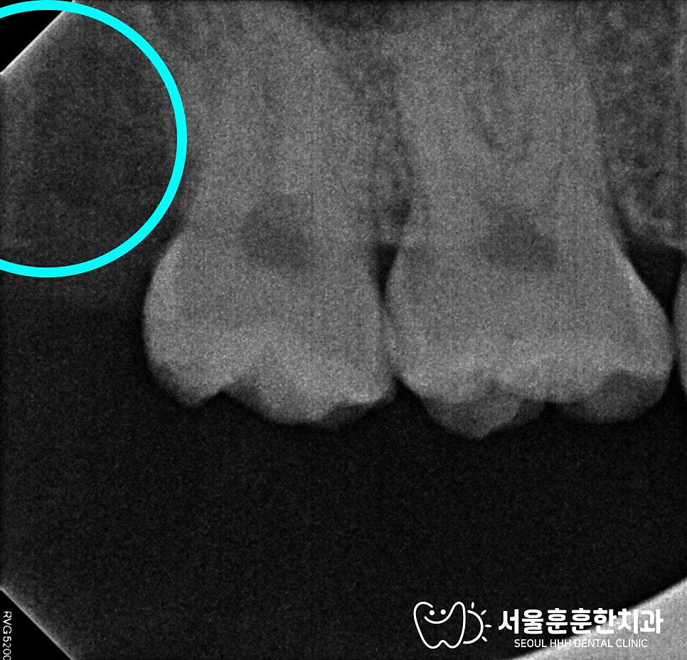 자양동치과 이전 수면마취 효과 부족 환자 마취 걱정 발치 전 확인