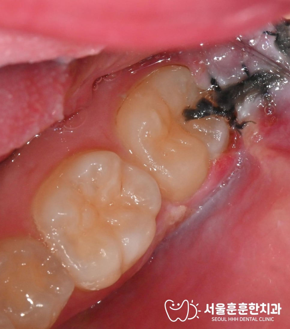 자양동치과 사랑니 통증 관리 실패 시 염증 발생 주의사항 내원 필요 판단