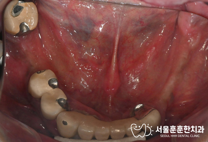 건대입구치과임플란트