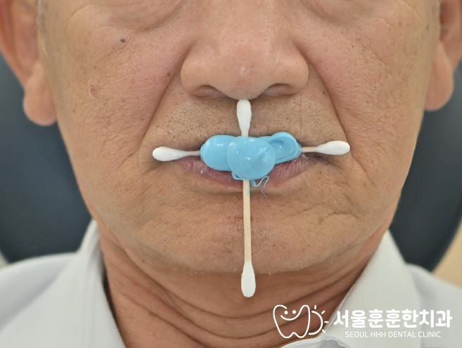 건대잇몸뼈임플란트치료