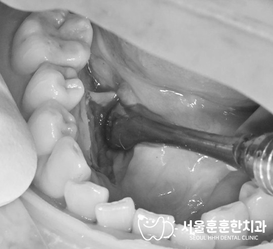 광진구골융기치료