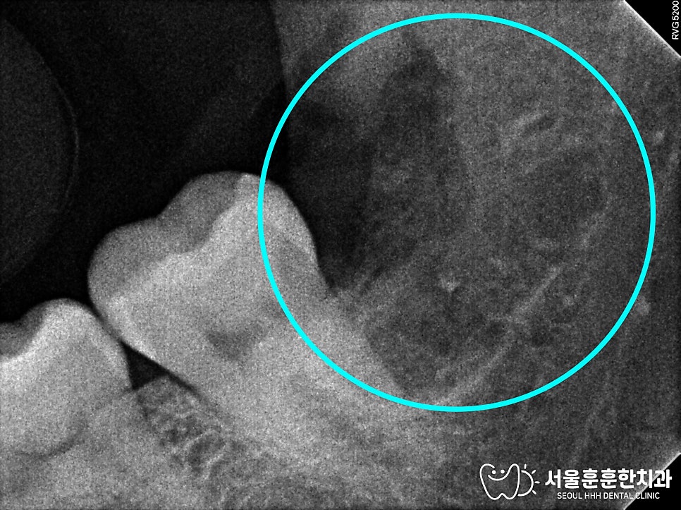 자양동사랑니발치잘하는곳사랑니발치치과