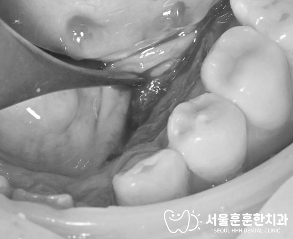 구강골융기수술