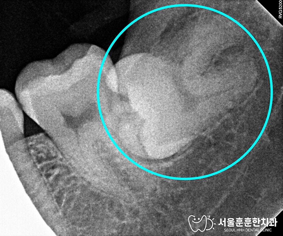 수면마취사랑니발치방법