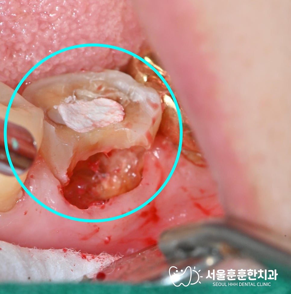 신경치료후치아보존방법