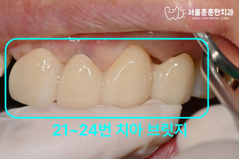 자양동치과브릿지통증원인치료