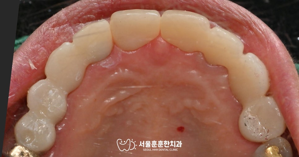자양동치과브릿지파손교체방법