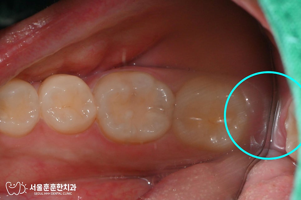 완전매복사랑니수술치과