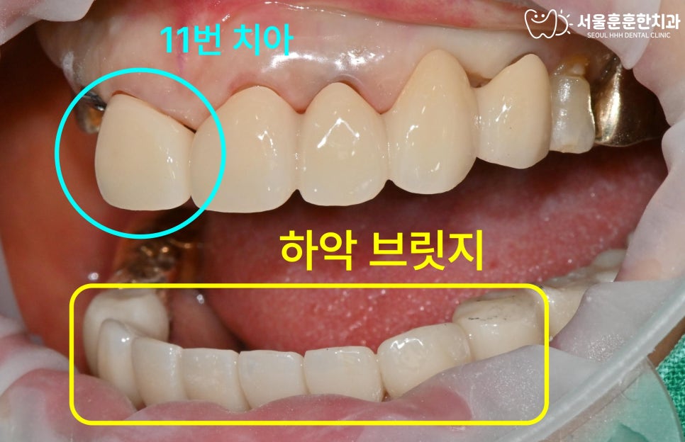 임플란트로자양동치과복원