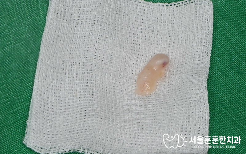 잇몸뼈튀어나옴수술치료